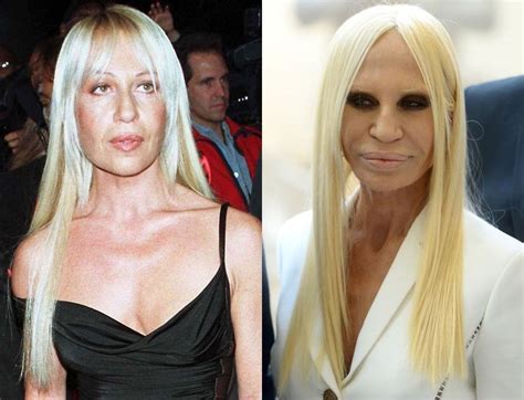 donatella versace in clinica|donatella versace before and after surgery.